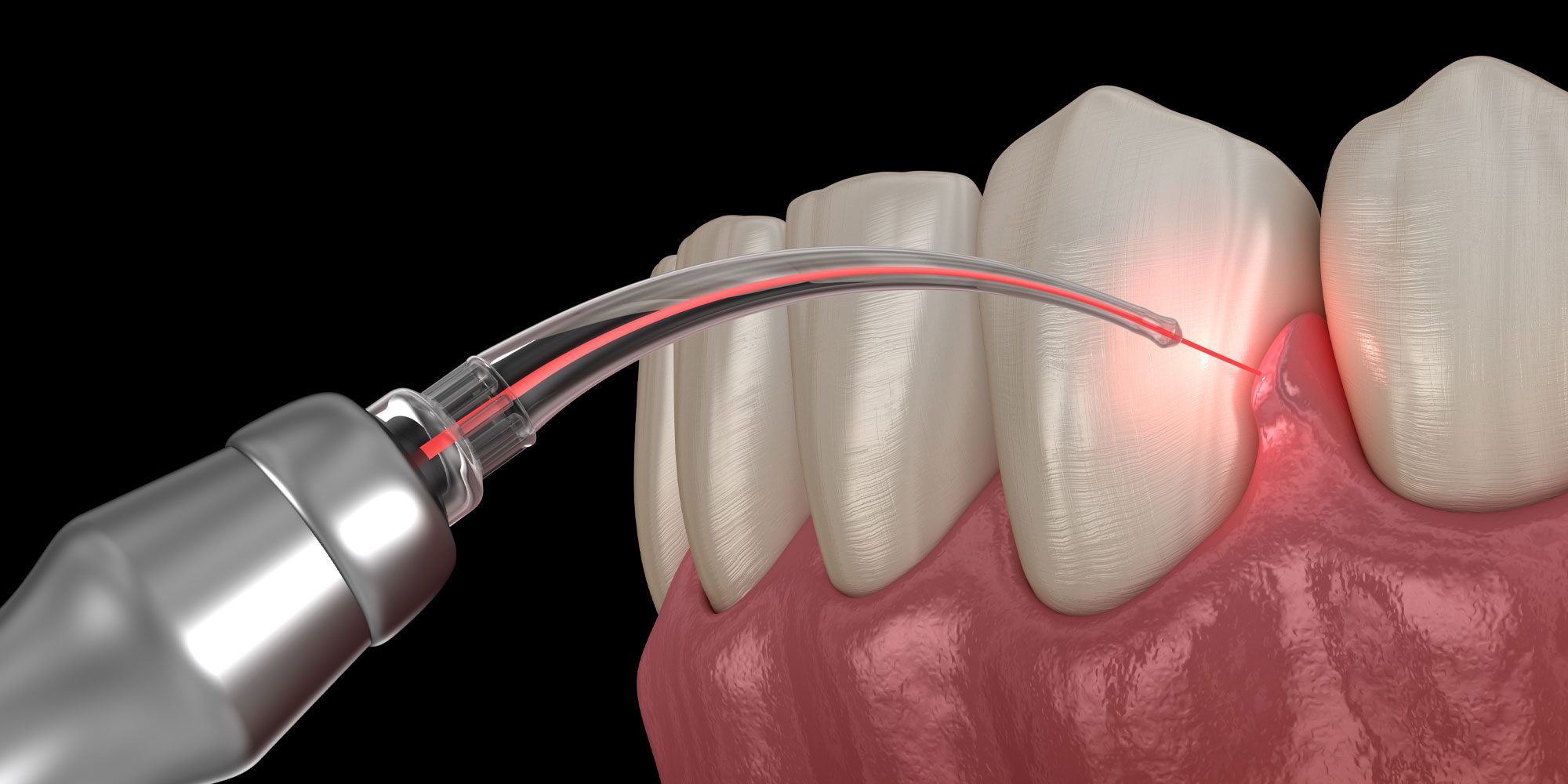 LANAP Dental Laser In Use For Clearing Gum Disease From A Patient's Gumline