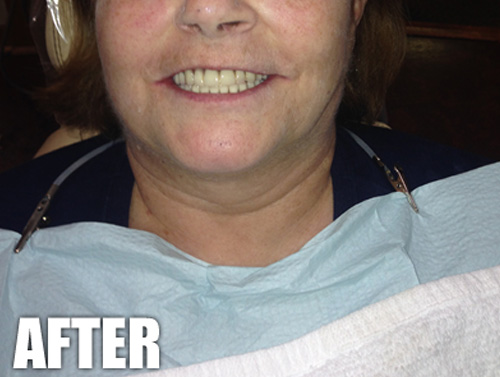Dental Patient After A Same Day Dental Implant Procedure