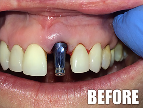 A Dental Implant Post In The Gumline Before The Crown Is Put On The Implant
