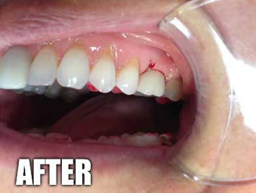 A Top Arch Of Teeth With The First Left Molar Replaced With A Permanent Dental Implant