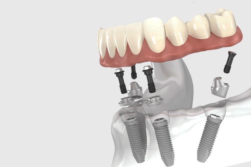 All On 4 Full Arch Dental Implant
