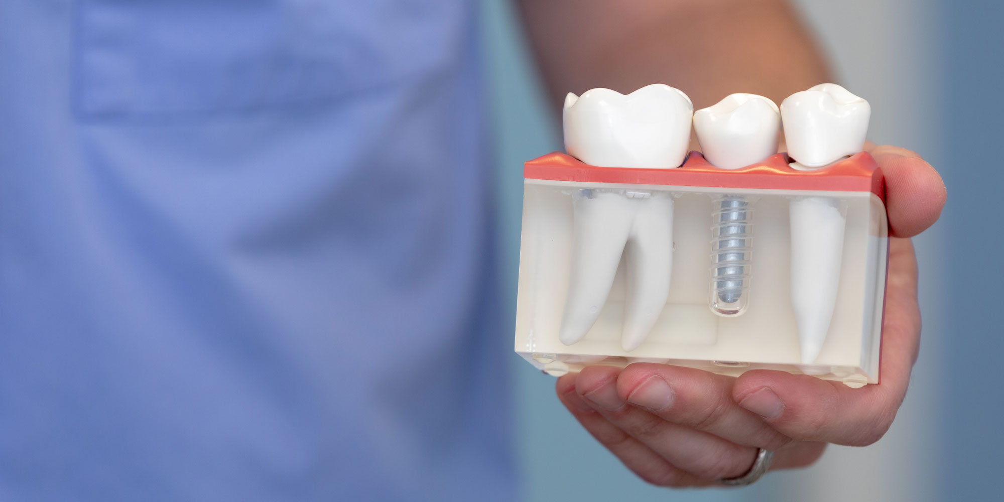Dental Implant Model Being Held By A Doctor