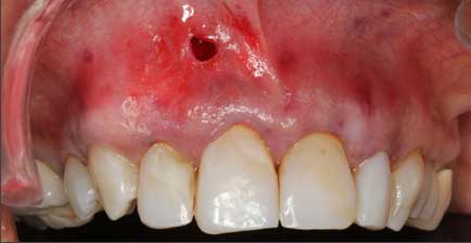 Dental Patient Before Healing From Pinhole Surgical Procedure, With A Hole In Their Gumline And Slightly Bloody