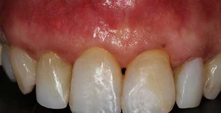 Dental Patient After Pinhole Surgical Technique Was Utilized To Fix His Gum Recession