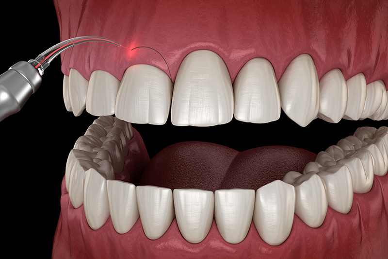 A Medically Accurate 3D Illustration Showing A Gingivectomy Surgery For Curing Periodontal Disease
