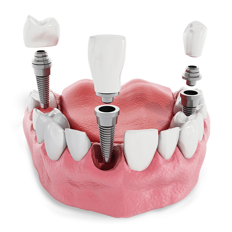 Three Dental Implants Placed Around The Front And Sides Of The Mouth, Showing Different Parts Of The Implant, Such As The Implants, The Abutments, And The Crowns