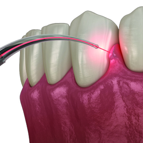 LANAP Laser Gum Disease Treatment Being Used To Treat Gum Disease