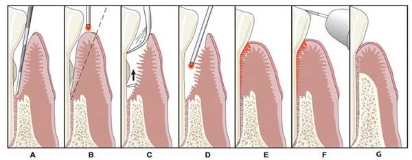 Chart Of 8 Different Steps Done During A LANAP Procedure To Cure Gum Disease Using A Dental Laser